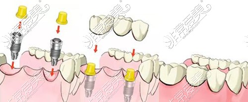 种植牙示意图