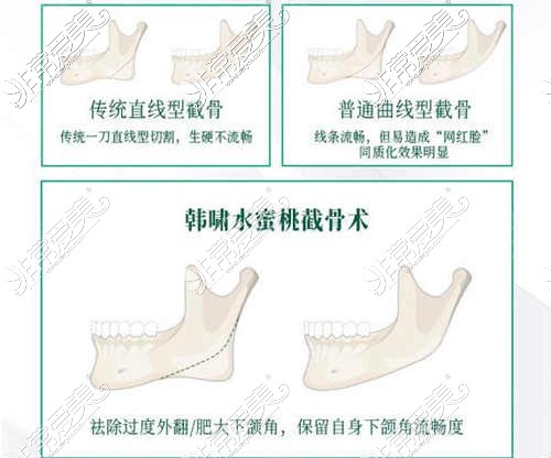 韩氏水蜜桃截骨