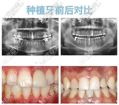 三门峡口腔医院种植牙<span style=