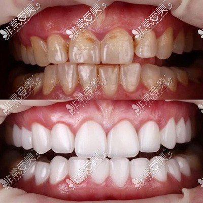 二氧化锆全瓷牙冠修复前后对比