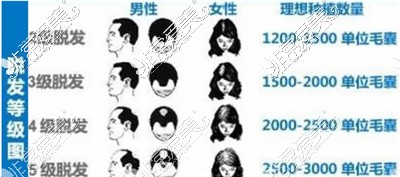 植发3000个毛囊价格是多少？3000个毛囊植发有多大面积?