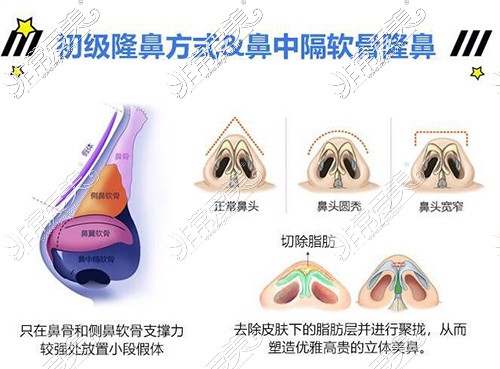 上海华美谢卫国做鼻子怎么样，分享隆鼻风格及真人案例！