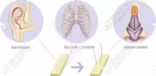 隆鼻方式示意图