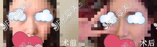 苏州美贝尔美容医院好不好?揭秘眼鼻吸脂等项目日记及价格!