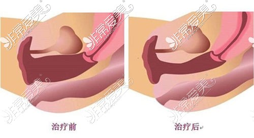 缩阴前后对比