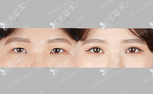 韩国原辰整形外科双眼皮手术案例