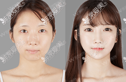韩国原辰整形外科隆鼻手术案例