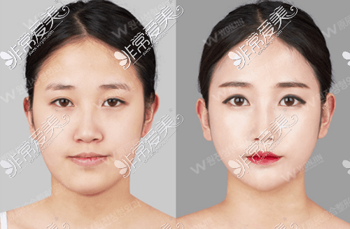 韩国原辰整形外科轮廓整形案例