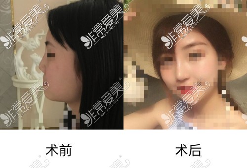 广州美莱整形医院隆鼻<span style=