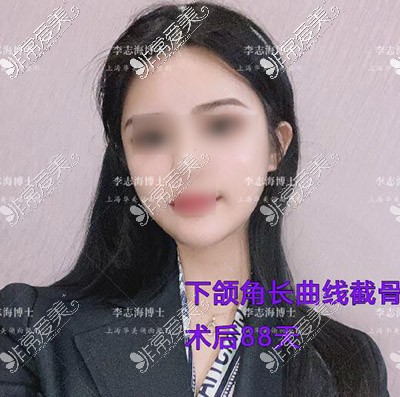 上海華美李志海磨骨88天照片