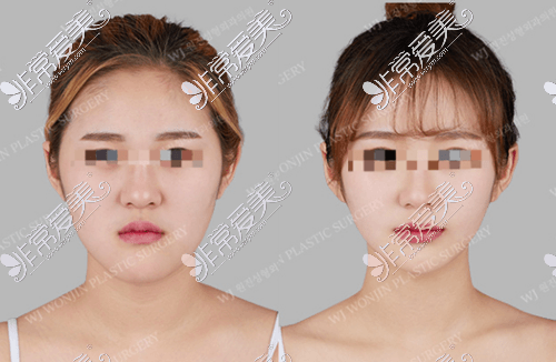 韩国原辰整形外科轮廓手术案例