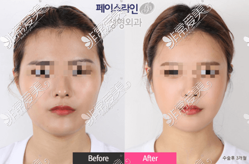 韩国菲斯莱茵faceline整形外科轮廓手术案例