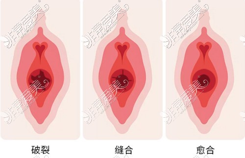 处女膜修复手术动画图