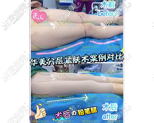 南京吸脂哪家医院比较好?盘点南#2Y*&x*b碑吸脂医院及特色优势!