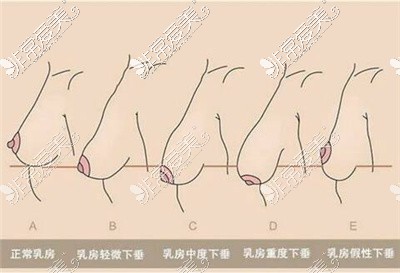 胸下垂松弛怎么解决?如果做胸下垂松弛手术多少钱？