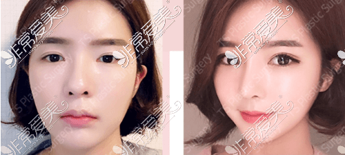 韩国TS整形外科双眼皮修复+提肌+鼻修复手术日记