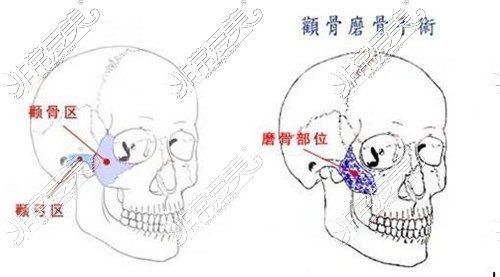 颧骨颧弓整形手术