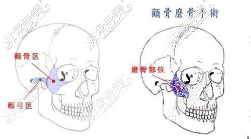 顴骨顴弓整形手術