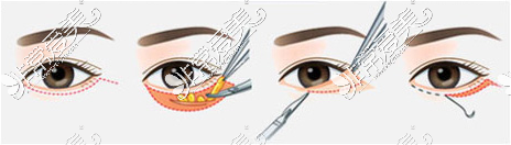 外路法去眼袋图示