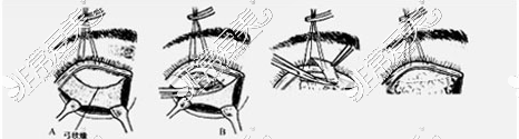 眶隔脂肪重置术图示
