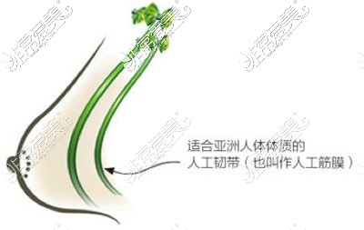 胸部韌帶提升術(shù)介紹