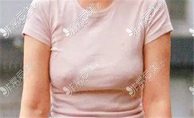 乳房假性下垂图片
