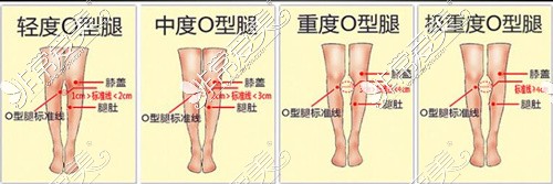 O型腿程度分級(jí)