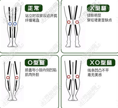 腿型分类图