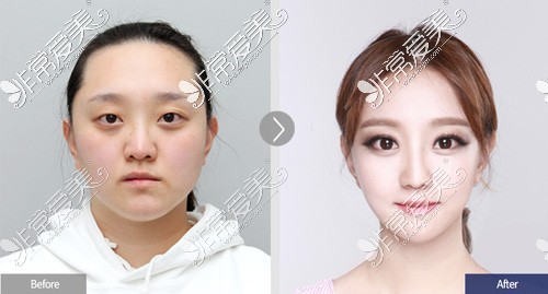 包子脸手术前后对比照