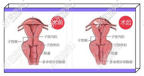 缩阴手术前后对比