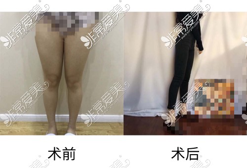 济南大腿环吸哪里好?推荐这几家吸脂医院效果好性价比高