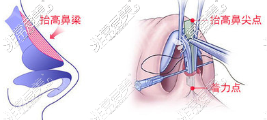 三角支架缝合