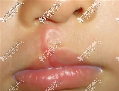 唇腭裂疤痕修复手术要多少钱 激光对唇裂手术疤痕有效吗 非常爱美