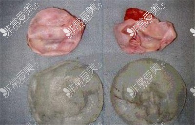 隆胸假体包膜挛缩实拍