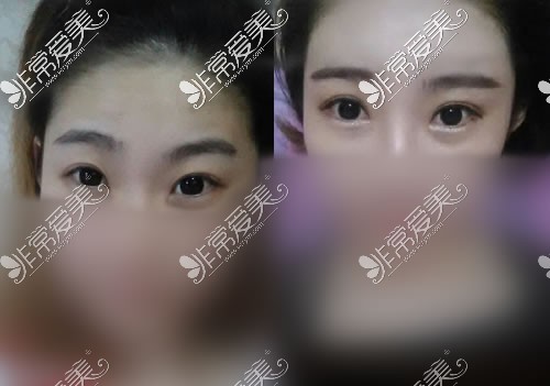 淄博张店壹美整形医院科普，杨文敬双眼皮修复怎么样？