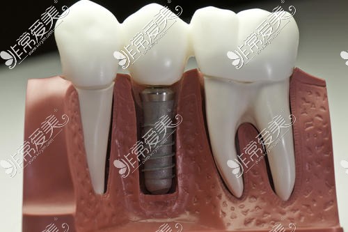 种植牙质量有什么区别？