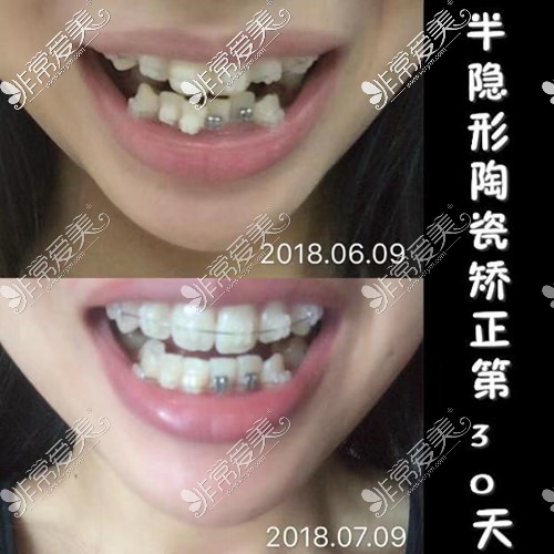 深圳半隐形陶瓷牙套矫正案例30天对比照片