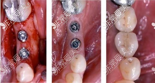 广州种牙多少钱一颗?种牙可以用医保吗?广州哪家口腔医院好