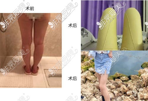 宁波壹加壹整形医院大腿吸脂