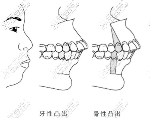 牙性突出和骨性突出区别