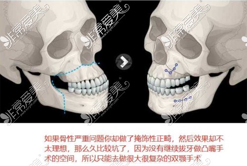 骨性凸嘴示意圖