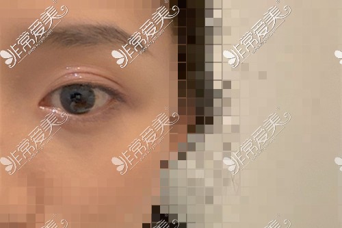 成都东篱医院徐敦医生的全切双眼皮+开眼角+去皮去脂+眼尾提升提升手术