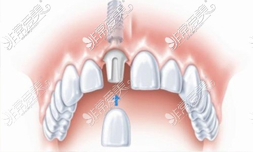种植牙示意图