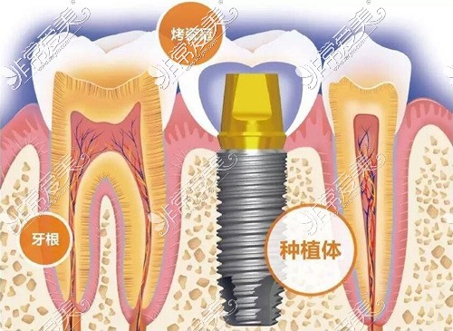 种植牙齿要有几个步骤？种植牙流程图及时间分享