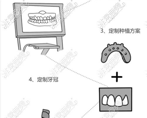 种植牙齿要有几个步骤？种植牙流程图及时间分享