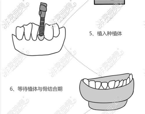 種植牙步驟圖解