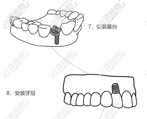 種植牙流程圖解