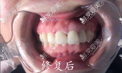 西安渡梦家口腔牙缝大修复后