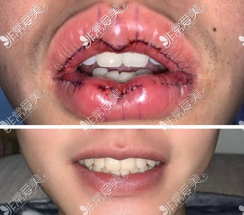 下图分别是术后即刻和厚唇改薄手术七天拆线的恢复情况