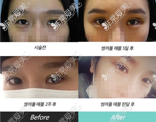 韩国eve整形外科双眼皮修复前后对比照片